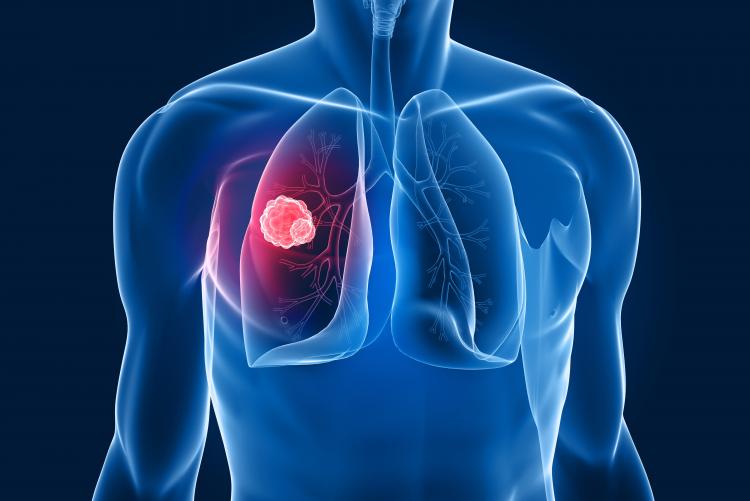 Câncer de pulmão pode ser causa de ginecomastia.
